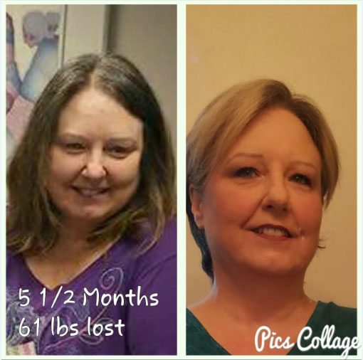 Debbie Trevino before and after weight loss photo at McCarty Weight Loss Center