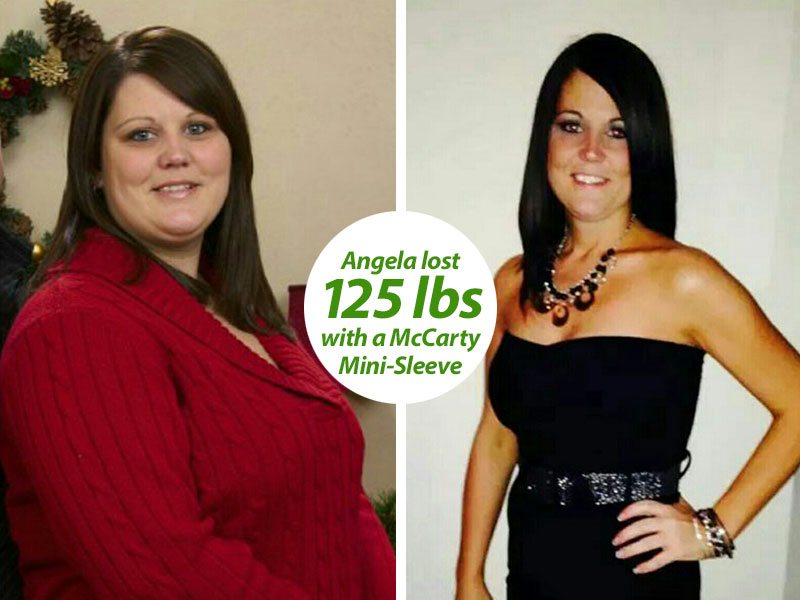 Angela before and after weight loss photo at McCarty Weight Loss Center