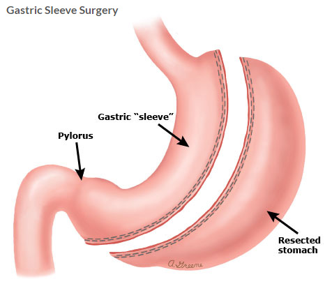 gastric mini sleeve surgery